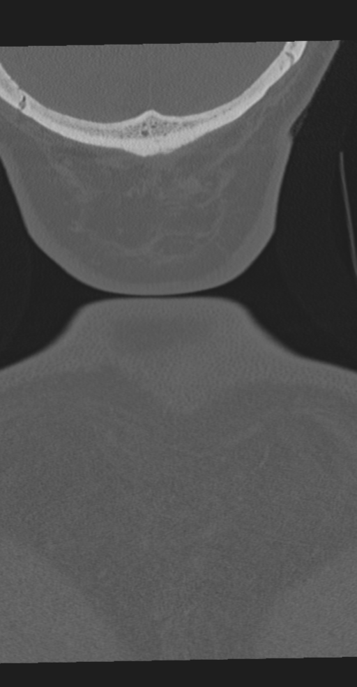 Cervical spine fracture in the setting of ankylosis (Radiopaedia 37038-38715 Coronal bone window 81).png
