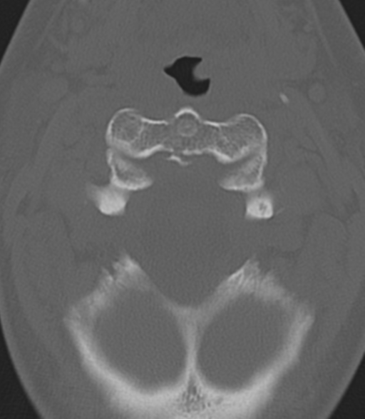 File:Cervical spine fractures with vertebral artery dissection (Radiopaedia 53296-59268 Axial bone window 15).png