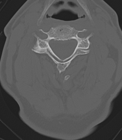 Cervical spine fractures with vertebral artery dissection (Radiopaedia 53296-59268 Axial bone window 26).png