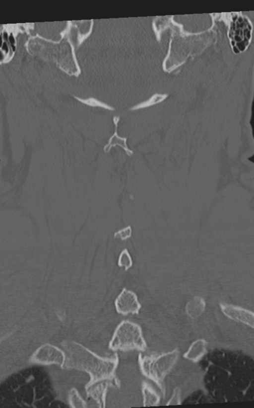 Cervical spine fractures with vertebral artery dissection (Radiopaedia 53296-59268 Coronal bone window 52).png