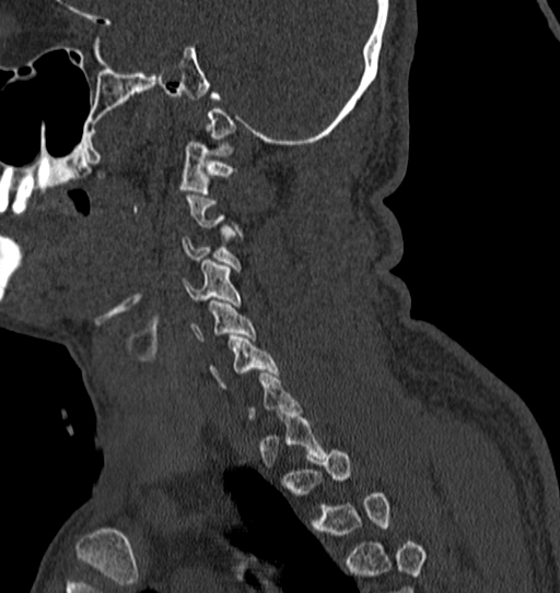 Cervical spine trauma with tear drop fracture and perched facet joint (Radiopaedia 53989-60127 Sagittal bone window 29).jpg