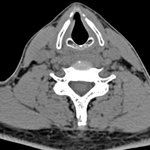 Cervical spondylodiscitis (Radiopaedia 28057-29489 Axial non-contrast 52).jpg