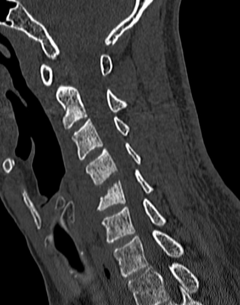 Cervical spondylodiscitis (Radiopaedia 28057-29489 Sagittal bone window 38).jpg