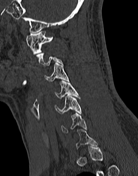 Cervical spondylodiscitis (Radiopaedia 28057-29489 Sagittal bone window 46).jpg