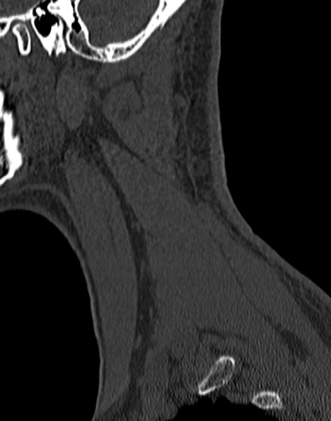 Cervical spondylodiscitis (Radiopaedia 28057-29489 Sagittal bone window 57).jpg