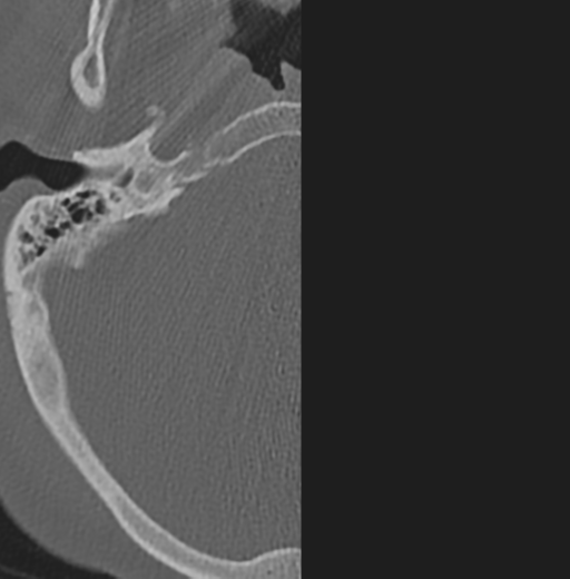 File:Cervical spondylolysis (Radiopaedia 49616-54811 Axial bone window 2).png