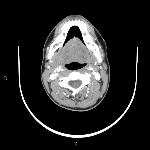 Cervical thymic cyst (Radiopaedia 88632-105335 B 77).jpg