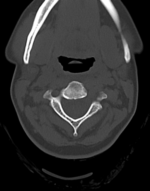 Cervical tuberculous spondylitis (Radiopaedia 39149-41365 Axial bone window 18).png