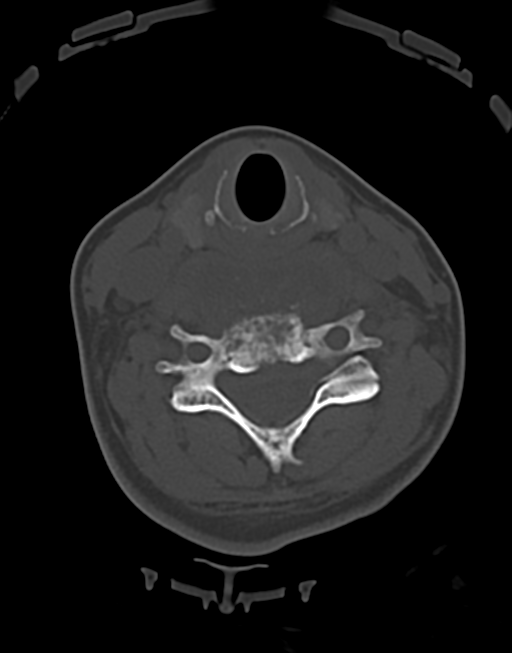 Cervical tuberculous spondylitis (Radiopaedia 39149-41365 Axial bone window 32).png