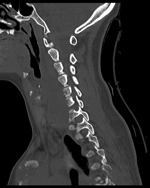 Cervical tuberculous spondylitis (Radiopaedia 39149-41365 Sagittal bone window 42).png