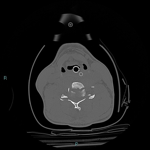 File:Cervical vertebral burst fracture (Radiopaedia 37420-39258 Axial bone window 20).jpg