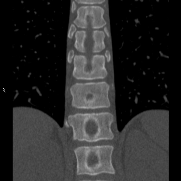 File:Chance fracture (Radiopaedia 36521-38081 Coronal bone window 30).jpg
