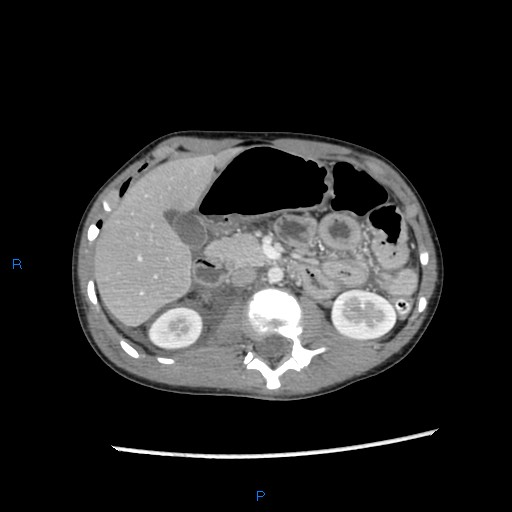 File:Chance fracture with duodenal and pancreatic lacerations (Radiopaedia 43477-46864 A 12).jpg