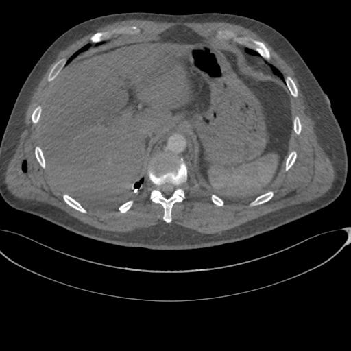 File:Chest multitrauma - aortic injury (Radiopaedia 34708-36147 A 271).png