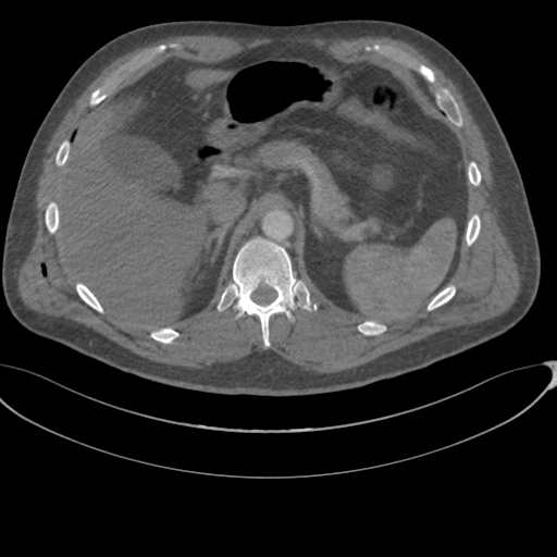 File:Chest multitrauma - aortic injury (Radiopaedia 34708-36147 A 294).png