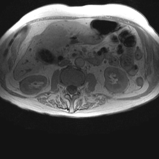 File:Cholangiocarcinoma - mass-forming pattern (Radiopaedia 16017-15677 T1 in-phase 22).jpg