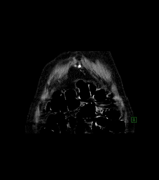 Cholangiocarcinoma with cerebral metastases (Radiopaedia 83519-98629 Coronal C+ delayed 6).jpg