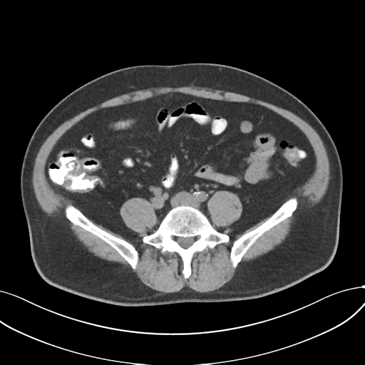 Cholecystitis with focal perforation and hepatic abscess (Radiopaedia 37189-38945 Axial non-contrast 57).png