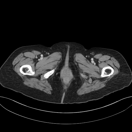 Cholecystoduodenal fistula due to calculous cholecystitis with gallstone migration (Radiopaedia 86875-103077 D 88).jpg