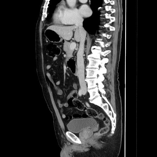 Choledocholiathiasis with normal caliber common bile duct (Radiopaedia 75368-86632 D 79).jpg