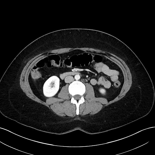 File:Choledocholithiasis after recent cholecystectomy (Radiopaedia 60929-68737 Axial 9).jpg