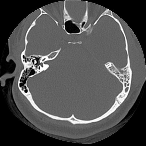 Cholesteatoma (Radiopaedia 84960-100474 Axial bone window 36).jpg