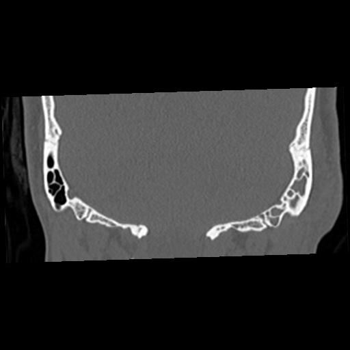 Cholesteatoma (Radiopaedia 84960-100474 Coronal bone window 59).jpg