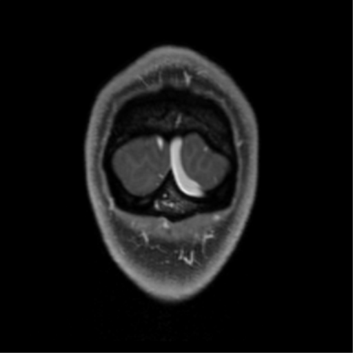 Chondrosarcoma (Radiopaedia 41937-44939 Coronal T1 C+ 16).png