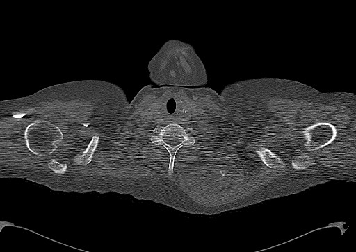 Chondrosarcoma - chest wall (Radiopaedia 65192-74199 Axial bone window 1).jpg