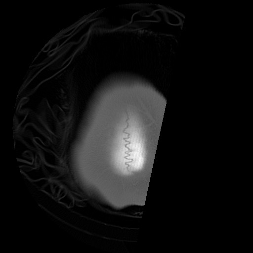 File:Chondrosarcoma - sphenoid wing (Radiopaedia 58259-67828 Axial bone window 29).jpg