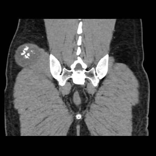 Chondrosarcoma of iliac wing (Radiopaedia 63861-72599 Coronal non-contrast 94).jpg