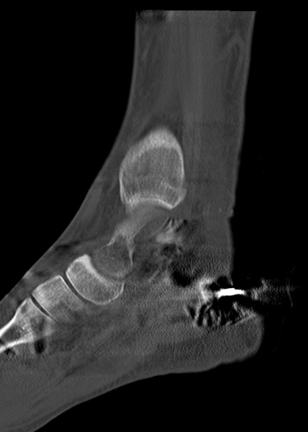 Chopart fracture (Radiopaedia 35347-36861 Sagittal bone window 34).jpg