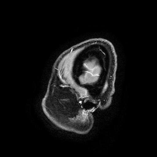 Chordoid glioma of third ventricle (Radiopaedia 91612-109340 F 192).jpg