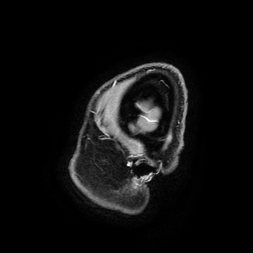 Chordoid glioma of third ventricle (Radiopaedia 91612-109340 F 193).jpg
