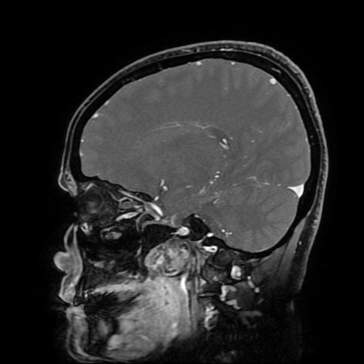 File:Chordoid glioma of third ventricle (Radiopaedia 91612-109340 F 84).jpg