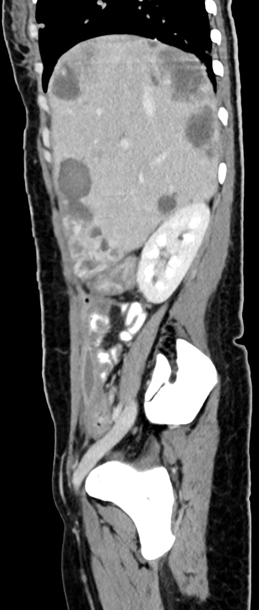 Choriocarcinoma liver metastases (Radiopaedia 74768-85766 C 125).jpg