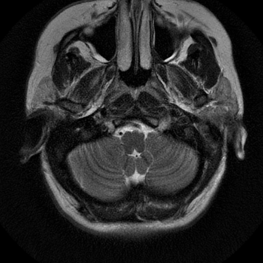 File:Choroid plexus xanthogranuloma (Radiopaedia 17650-17386 T2 22).jpg