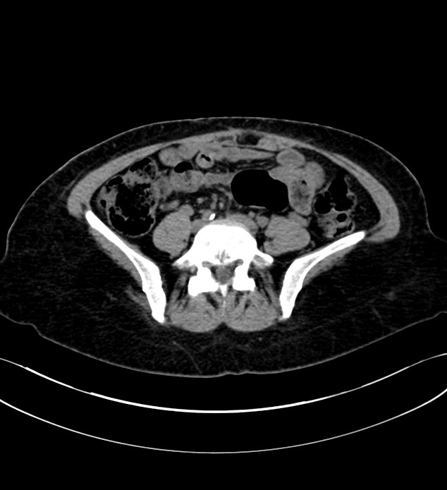 Chromophobe renal cell carcinoma (Radiopaedia 84290-99582 Axial non-contrast 99).jpg