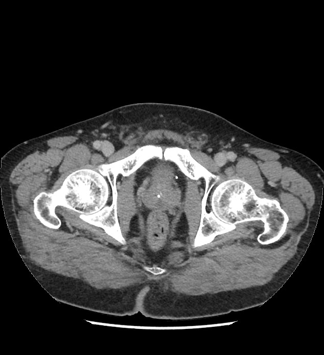 Chromophobe renal cell carcinoma (Radiopaedia 86879-103083 C 150).jpg