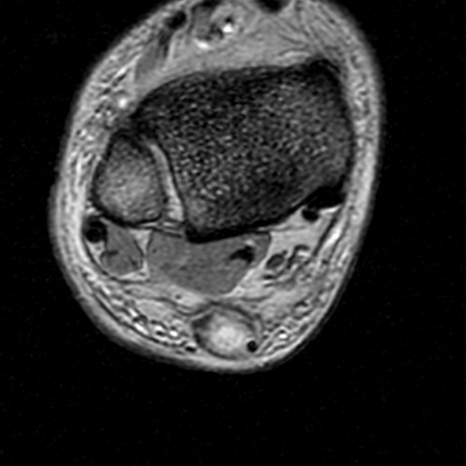 File:Chronic Achilles tendon rupture (Radiopaedia 15262-15100 Axial Gradient Echo 9).jpg