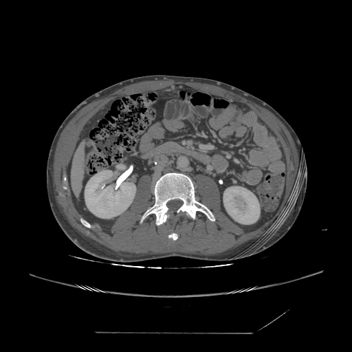 File:Chronic IVC thrombosis and resultant IVC filter malposition (Radiopaedia 81158-94800 A 99).jpg
