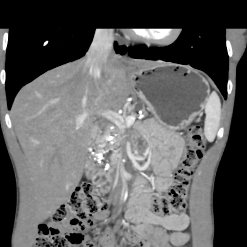 File:Chronic calcific pancreatitis (Radiopaedia 56280-62953 E 8).jpg