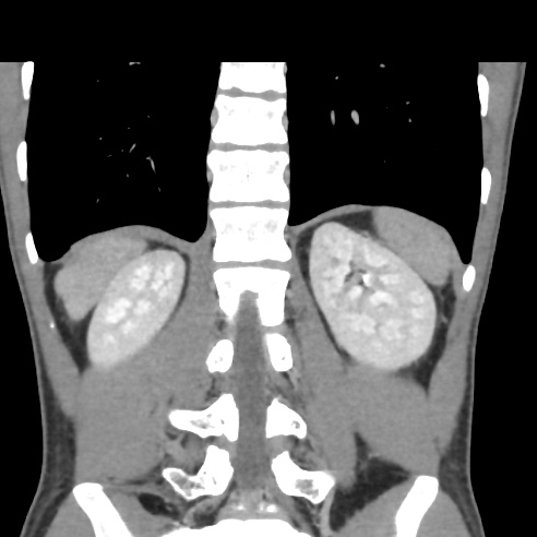 File:Chronic calcific pancreatitis (Radiopaedia 56280-62953 F 27).jpg