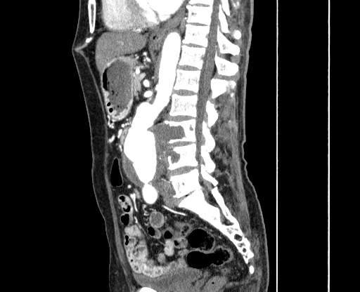 Chronic contained rupture of abdominal aortic aneurysm with extensive erosion of the vertebral bodies (Radiopaedia 55450-61901 B 34).jpg