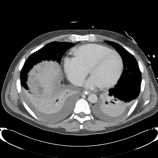Chronic diverticulitis complicated by hepatic abscess and portal vein thrombosis (Radiopaedia 30301-30938 A 5).jpg
