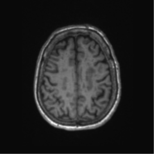 Chronic hypertensive encephalopathy (Radiopaedia 72844-83495 Axial T1 21).png