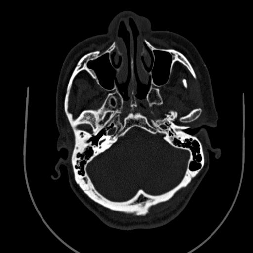 Chronic invasive fungal sinusitis (Radiopaedia 91563-109286 Axial sinus 29).jpg