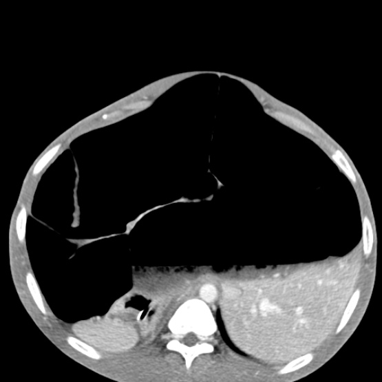 Chronic large bowel pseudo-obstruction (Radiopaedia 43181-46492 A 52).jpg