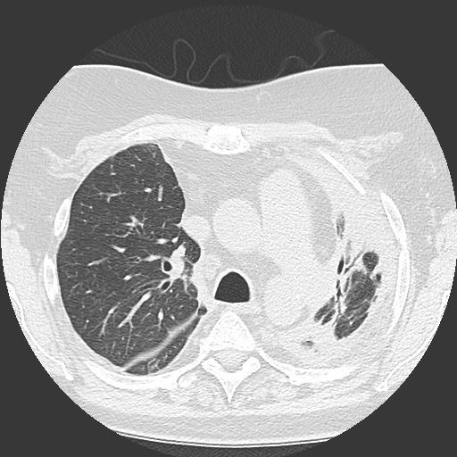Chronic lung allograft dysfunction - restrictive form (Radiopaedia 60595-68316 Axial lung window 24).jpg