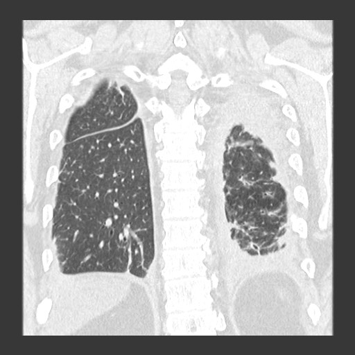 Chronic lung allograft dysfunction - restrictive form (Radiopaedia 60595-68316 Coronal lung window 76).jpg